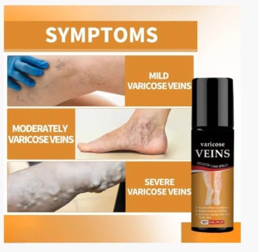 Bees Venom Spray Natural Relief For Varicose Veins & Spider Veins (Pack Of 2)